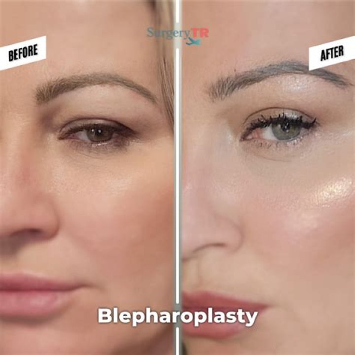 Blake Lively | Nose Job And Plastic Surgery Before And After