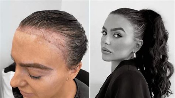 Glimpse Of Joey Logano Hair Transplant Before and After